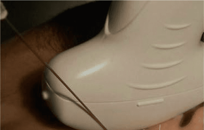 상완신경총 - Figure 8 - 원문 캡션입니다 (자동 번역 실패 — 원문 표기): Figure 8.  The long thoracic and dorsal s